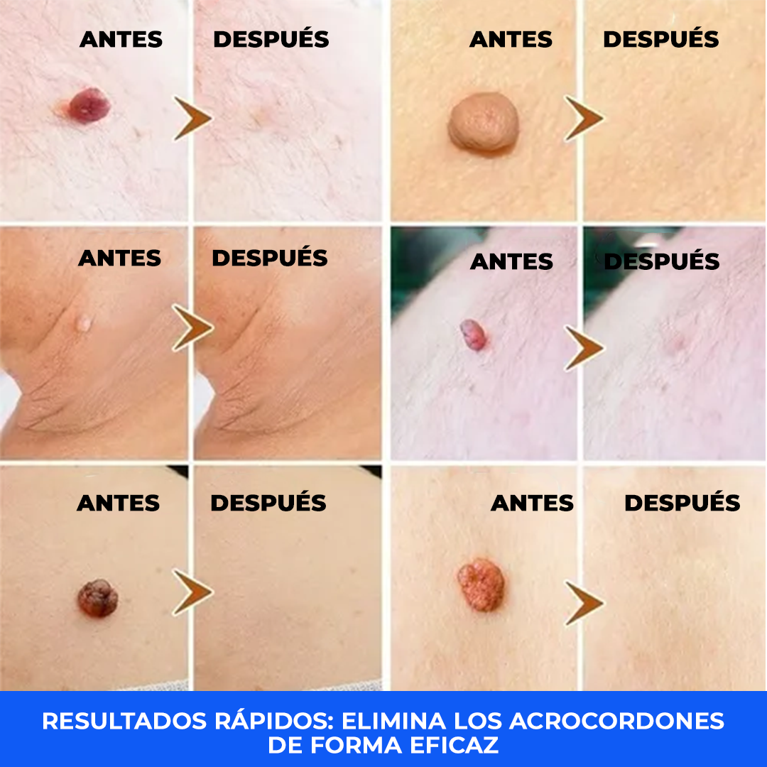 El Eliminador Definitivo de Verrugas - DermaZero