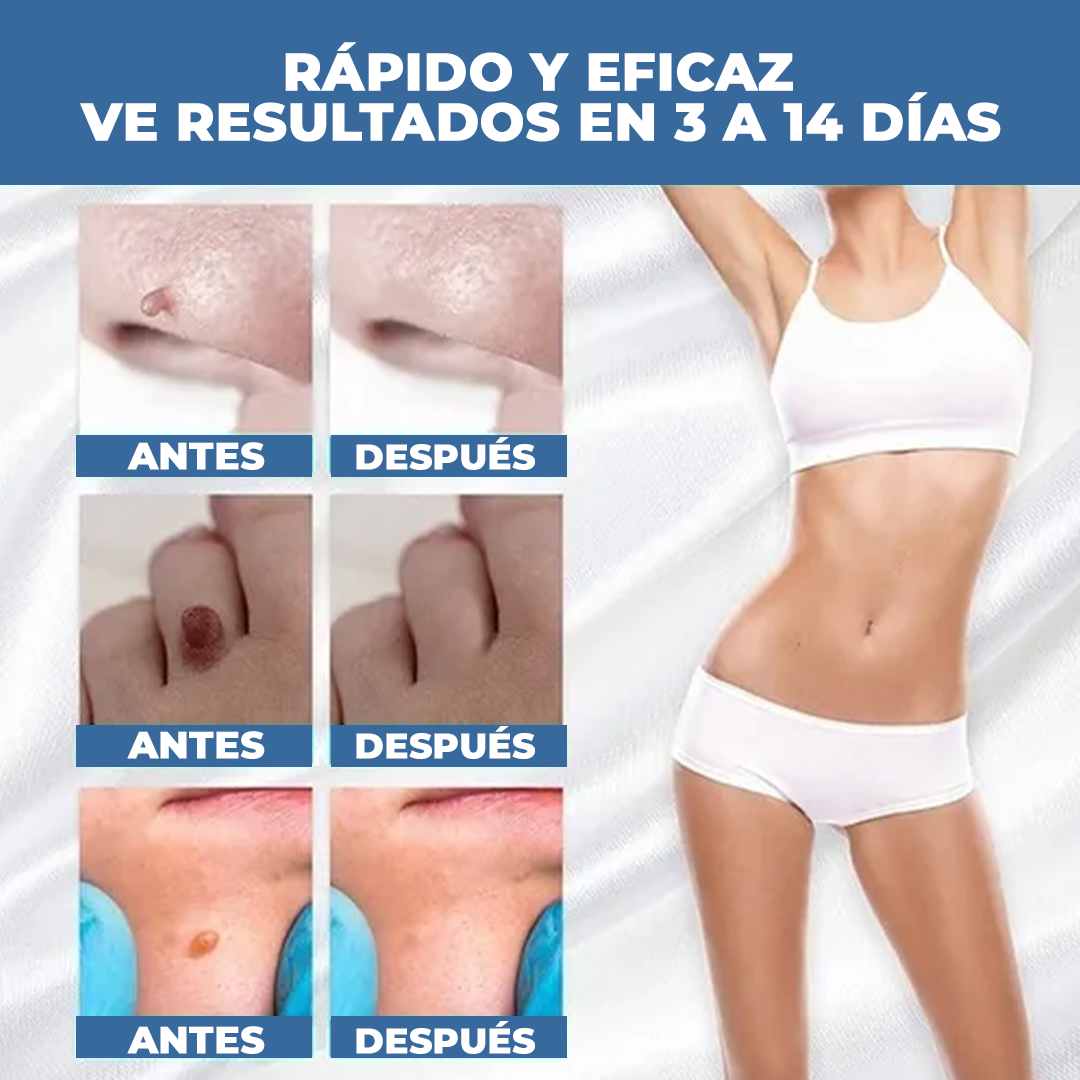 El Eliminador Definitivo de Verrugas - DermaZero