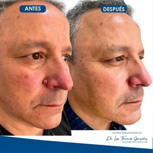 El Eliminador Definitivo de Verrugas - DermaZero
